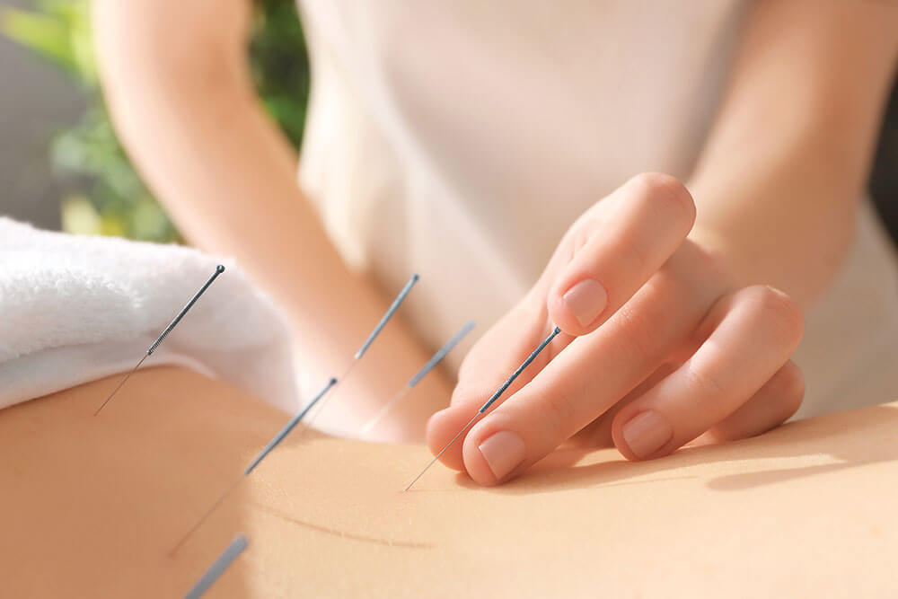 Everything You Need To Know About Acupuncture